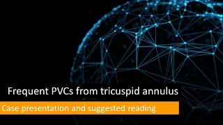 Frequent PVCs from RV inflow tricuspid annular PVC [upl. by Bennet]