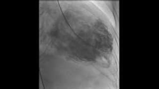 HAKIMVISTA MIOCARDIOPATIA DILATADA VENTRICULOGRAMA CON TROMBO INTRAVENTRICULAR [upl. by Lyrad]