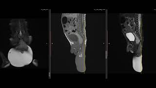 case 18 2 weeks baby born with swelling [upl. by Depoliti99]