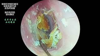 Earwax cleaning on the eardrum ｜573 [upl. by Astor]