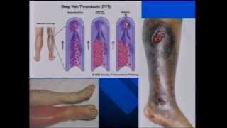 Lecture 14 Thrombotic Disorders 1 [upl. by Tersina]