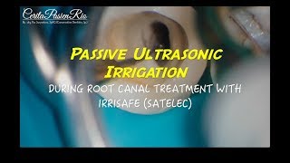 passive ultrasonic irrigation with irrisafe satelec in endodontic treatment [upl. by Enelyad439]