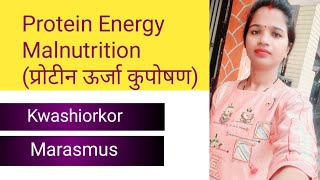 Protein Energy Malnutritionप्रोटीन ऊर्जा कुपोषण।kwashiorkormarasmusक्वाशियोरकोरमैरास्मस [upl. by Rhona488]