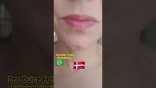 Queilite esfoliativa antes e depois Exfoliative cheilitis before and after [upl. by Krishna]