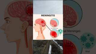 Meningitismedicine healthtips mbbs physiologyhealth healthcaresymptoms treatmentmeningitis [upl. by Statis754]