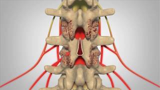 Laminectomy  Patient Education [upl. by Ojahtnamas405]