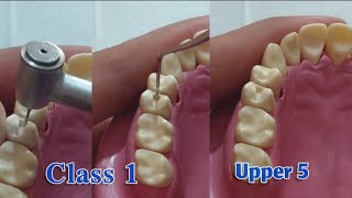 class 1 upper 5 cavity preparation for amalgam restoration [upl. by Eiramnaej625]