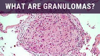 What are Granulomas  Pathology mini tutorial [upl. by Yelknirb389]