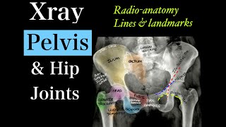 Xray Pelvis amp BL hip l Anatomyl Viewsl Linesl Landmarksl Measurementsl Adult amp Pediatric hip [upl. by Trillbee4]