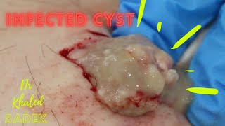 trailer infected cyst shorts Dr Khaled Sadek LipomaCystcom [upl. by Jenda296]