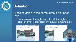 Understanding Homonymous Hemianopia Causes Symptoms and Treatment  Visual Impairment Explained [upl. by Weslee]