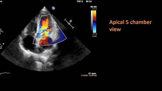 Bicuspid aortic valve with infective endocarditis II Full Echocardiography Assessment [upl. by Noe13]