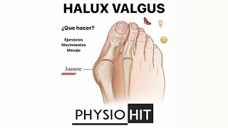 EJERCICIOS PARA EL JUANETE O HALUX VALGUS FISIOTERAPIA Y REHABILITACION [upl. by Suzann387]