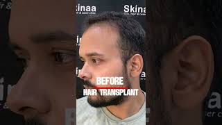 Hair Transplant Transformation Incredible Before amp After Results at Skinaa Clinic viral shorts [upl. by Atilemrac]