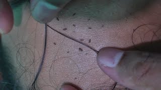 Lice Killing From Forehed  ASMR LICE POPPING SOUNDS [upl. by Surtemed]