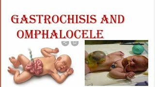 Gastroschisis and Omphalocele [upl. by Nyloc]