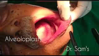 Alveoloplasty Surgery  Ridge remodelling for Denture Placement [upl. by Notsob]