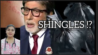 SHINGLES amp SHINGLES VACCINE In HINDI You must know drdeepshikhashah shingles familydoctor [upl. by Utas]