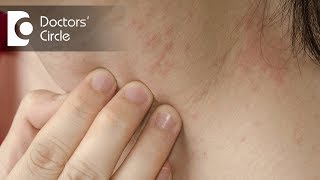 How to identify scabies rash amp its management  Dr Sudheendra Udbalker [upl. by Emmeline579]