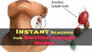 How to Get Rid of Swollen Lymph Nodes Naturally  5 Remedies for Swollen Lymph Nodes in Neck [upl. by Sherlocke]