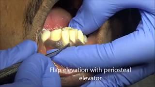 Supernumerary tooth extaction using forceps [upl. by Benioff929]