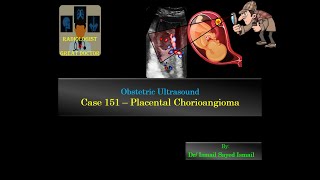 Ultrasound Case 151  Placental Chorioangioma [upl. by Hallette]