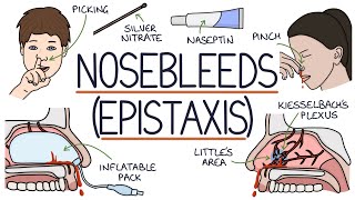 Understanding Nosebleeds Epistaxis [upl. by Nnaael]