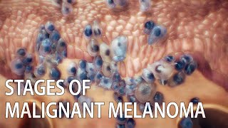 Malignant melanoma animation  skin cancer  SkinCancer MalignantMelanoma MelanomaAwareness [upl. by Mallissa742]