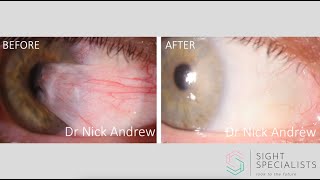 Pterygium surgery explained [upl. by Telracs]