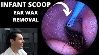 Infant Scoop VS The Stickiest Ear Wax Extraction Osteoma On Canal Wall [upl. by Boutis763]