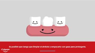 Extracción dental cómo prevenir la alveolitis  Colgate® [upl. by Natasha]