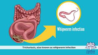 Trichuriasis Causes Signs and Symptoms Diagnosis and Treatment [upl. by Zsazsa]