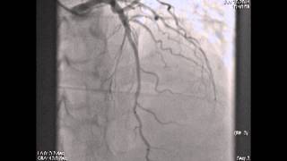 Myocardial Bridging [upl. by Berri]