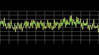 Multiple Myeloma  Rife Frequencies [upl. by Ahsekyw485]