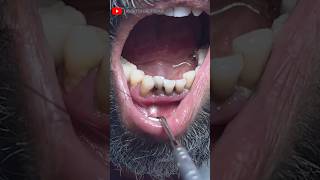 Extraction of Decayed Front Aesthetic Teeth toothextraction rootcanaltreatment dentistry [upl. by Millwater]