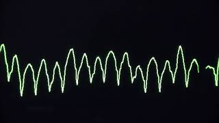 Cardiac arrest rhythms VF VT Asystole and PEA [upl. by Durrell894]