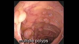 Colonoscopy FollowUp of Colon Polyp  Los Angeles Colonoscopy [upl. by Corel]