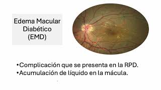 RPD tx laser y edema macular  Dra Argeñal [upl. by Welbie]