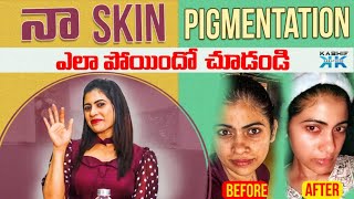 నా SKIN PIGMENTATION ఎలా పోయిందో చూడండి  RJ Kajal  Kashif Kreations [upl. by Sukramed]