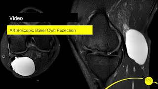 Operationsvideo Arthroskopische Bakerzystenresektion [upl. by Squire]