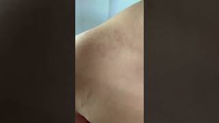 Pityriasis Rosea  Sanjeevani Skin Clinic India [upl. by Pinter]