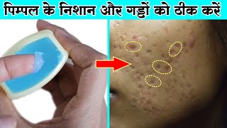 चेहरे के गड्ढे और निशान ठीक करने के कामियाब नुस्खे  Get Rid of Acne Scars Marks amp Dark Spots [upl. by Swagerty]