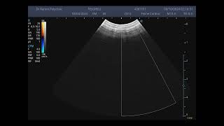 feline echo congenital heart disease Made with Clipchamp [upl. by Llekcm]