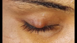 Chalazion Incision amp Curettage HD [upl. by Aime78]