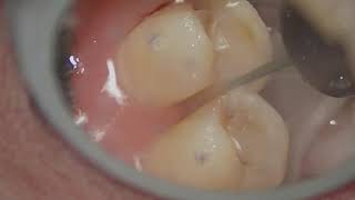 Maxillary premolar crown preparationproximal reduction under mirror view [upl. by Past601]