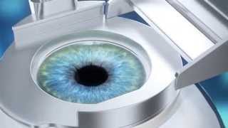 Super LASIK  визуализация процесса коррекции зрения [upl. by Ylerebmik]