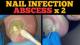 Ingrown Nail Infection Abscess  Second Nail Will Shock You [upl. by Saffian319]