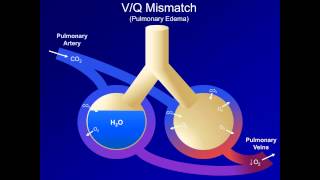 Hypoxia and Hypoxemia Mechanisms and Etiologies ABG Interpretation  Lesson 18 [upl. by Canica]