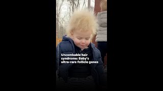 Baby Locks hair isnt styled its a rare condition uncombablehairsyndrome [upl. by Lsil]