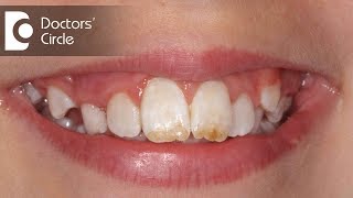 How do you treat Dental Fluorosis  Dr Aniruddha KB [upl. by Ssac]